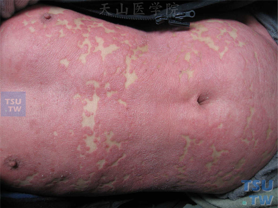 红皮病型银屑病：胸腹部弥漫浸润性红斑，表面少许细碎鳞屑