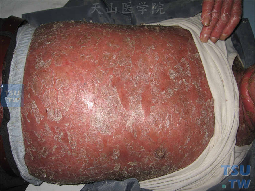红皮病型银屑病：周身弥漫潮红浸润肿胀，表面被覆片状灰白色鳞屑
