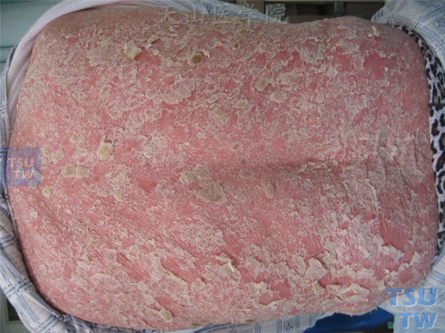 红皮病型银屑病：后背部浸润性红斑基础上大量脱屑