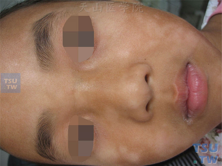 白色糠疹（pityriasis alba）的症状表现