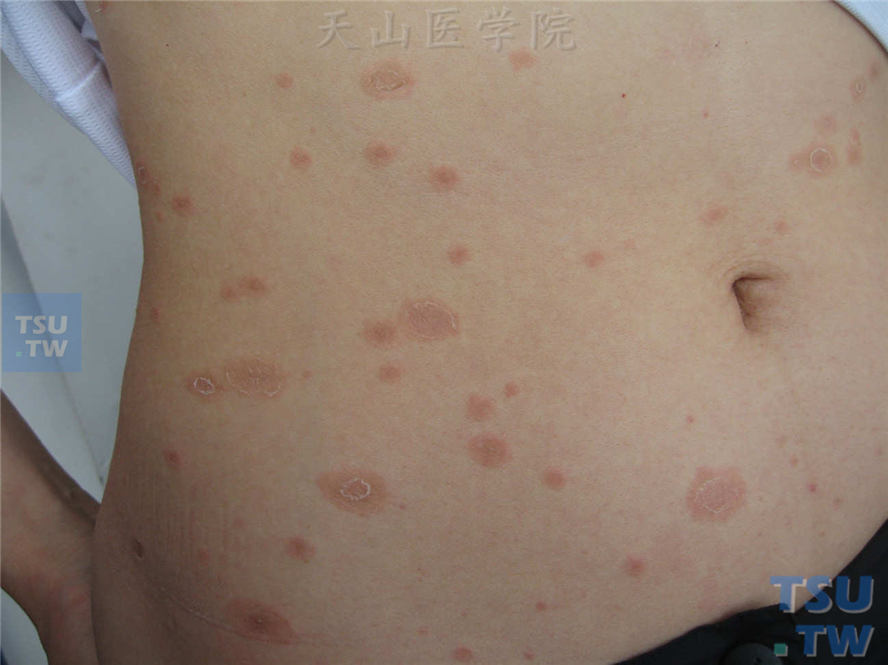 玫瑰糠疹(pityriasis rosea)的症状表现