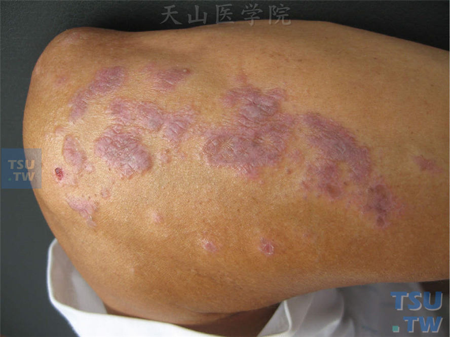 扁平苔藓-肘关节伸侧浸润性紫红扁平丘疹、斑块，表面光滑有光泽