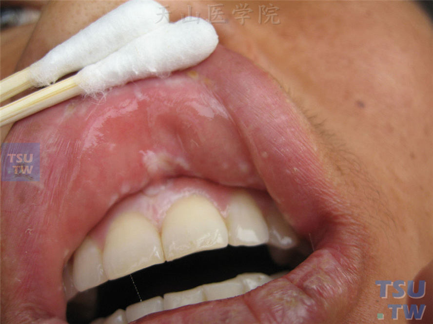 扁平苔藓-同一病人上唇内侧黏膜改变