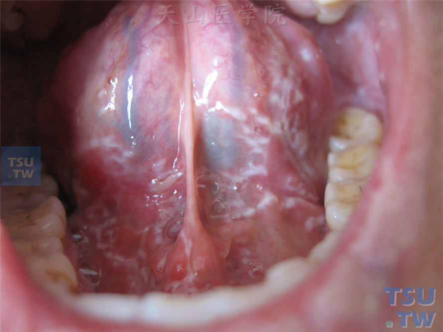 扁平苔藓-同一病人舌部黏膜改变