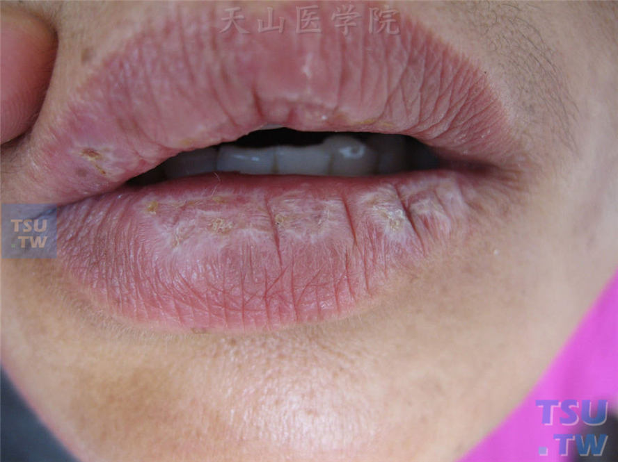 扁平苔藓-同一病人唇部干燥性斑疹，表面萎缩结痂
