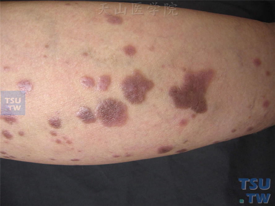 扁平苔藓-红褐色斑疹，部分皮损表面轻度增生样改变