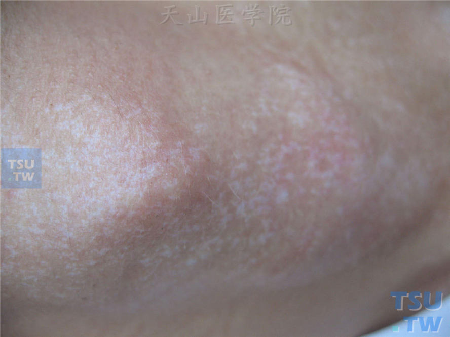 肘关节周围密集米粒至绿豆大小瓷白色斑疹，表面轻度萎缩，有光泽