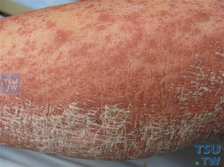 小腿伸侧毛囊性角化性丘疹，表面被覆鳞屑，触之较硬
