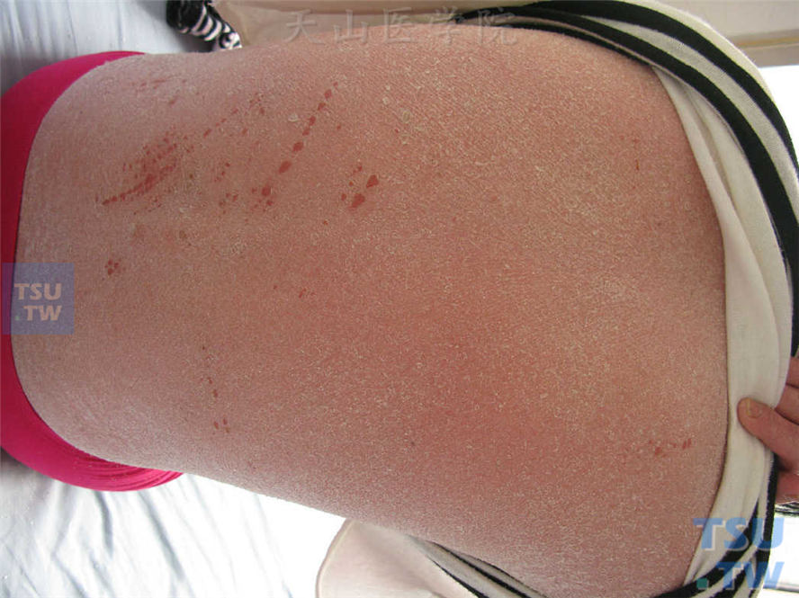 毛发红糠疹（pityriasis rubra pilaris）的症状表现