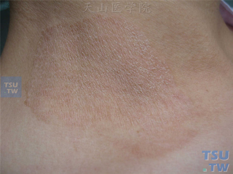 连圈状糠秕疹(pityriasis circinata)症状表现