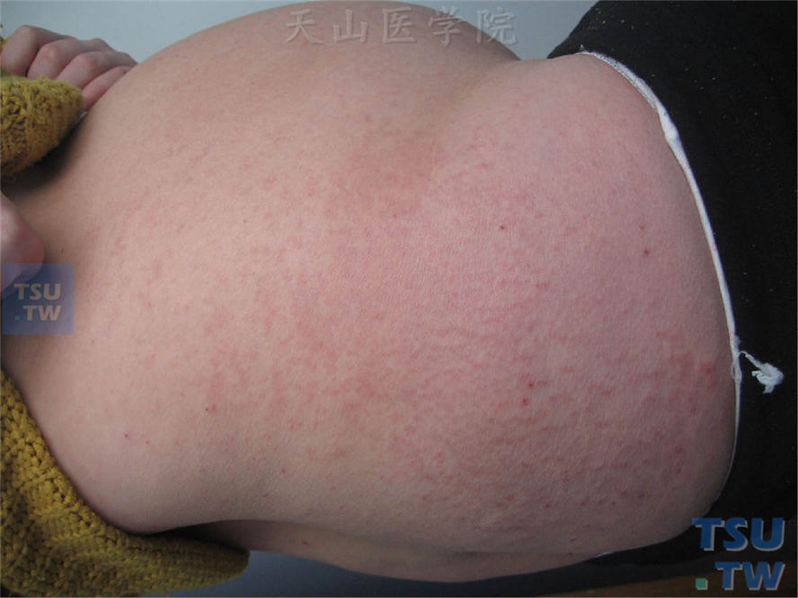 妊娠中期发生的股臀部红斑，形态单一