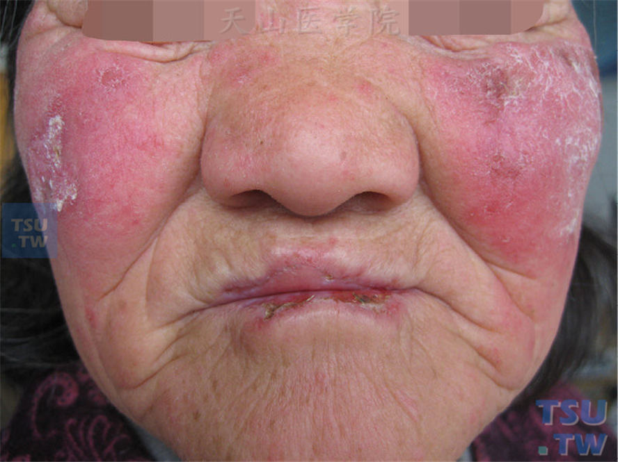 双侧面颊、口唇紫红斑，表面毛细血管扩张并附有粘着性鳞屑，中央微凹萎缩，边缘炎症明显