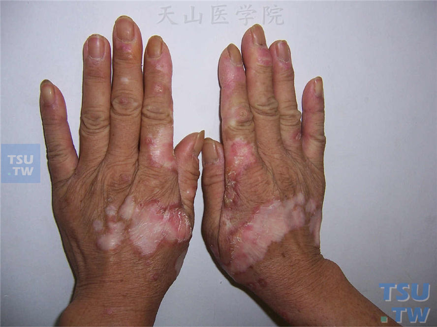 手背大小不等的色素减退斑片，中央表面有萎缩、毛细血管扩张，边缘少许粘着性鳞屑