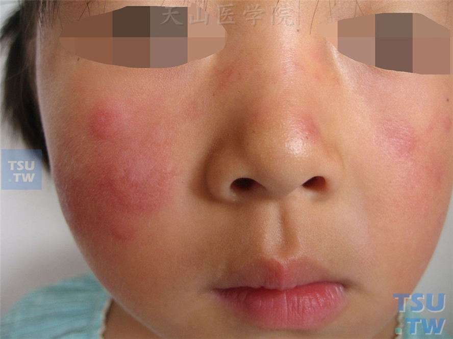 环形红斑型：面颊、鼻部圆形或环形水肿性红斑，边缘隆起，中央消退后留色沉或色减斑，可见少许毛细血管扩张