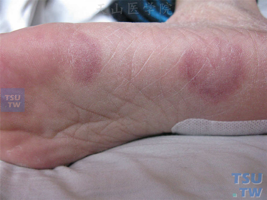 环形红斑型：足底圆形或环形水肿性紫红斑