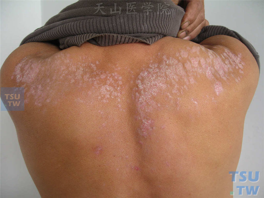 丘疹鳞屑型：后背部淡红色斑疹、丘疹，表面被覆鳞屑，似银屑病样