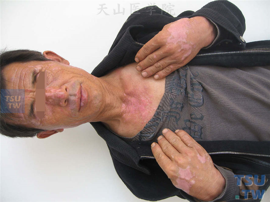 丘疹鳞屑型：面部、颈部V型区、手背浸润性红斑，部分皮损消退留色沉或色减斑