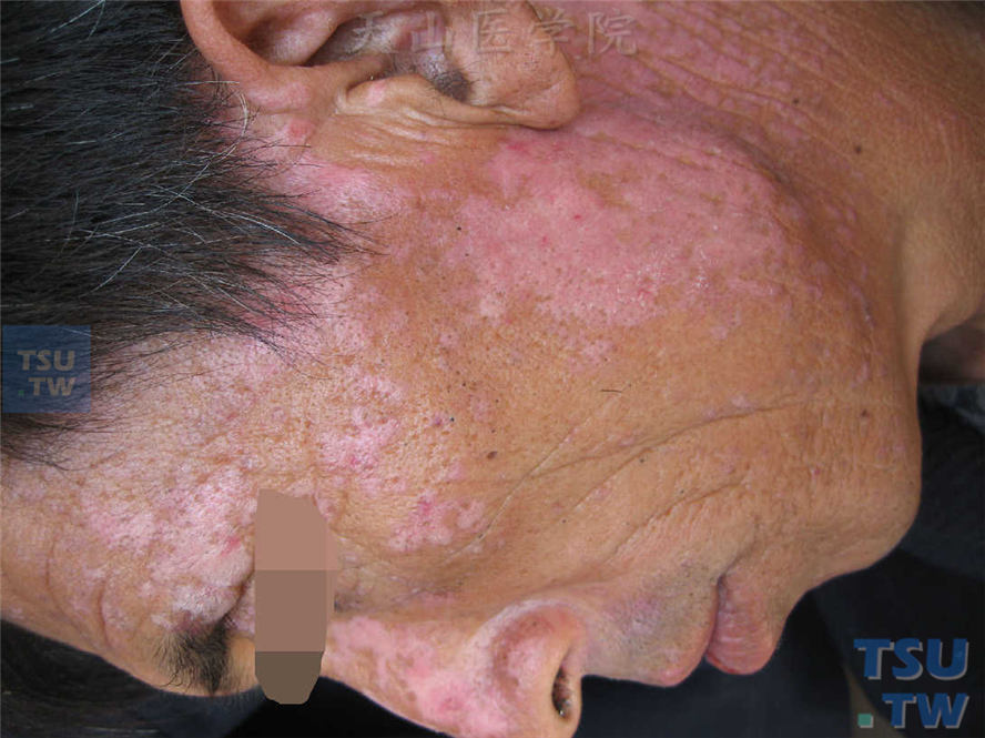 同一病人面颈部皮损近照，可见银屑病样浸润性红斑、色减斑，边缘色素加深