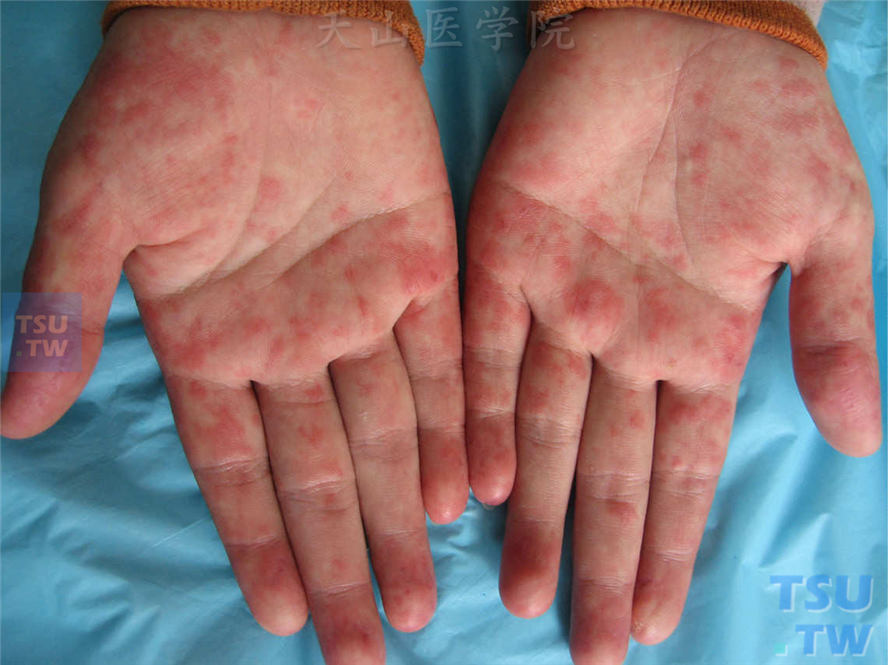 系统性红斑狼疮-同一病人，手部毛细血管扩张性红斑，指尖可见瘀点、点状萎缩