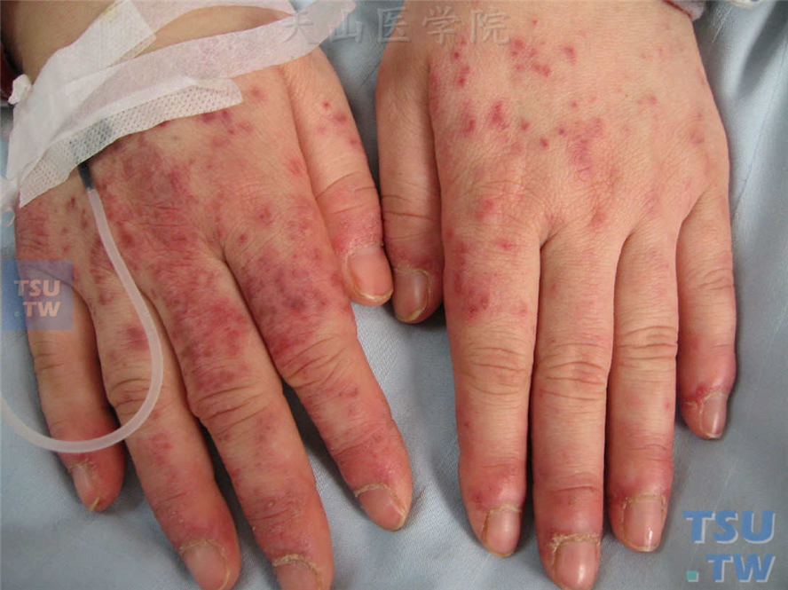 系统性红斑狼疮-同一病人，手背部水肿性红斑、瘀点等血管炎样损害，可见甲周红斑