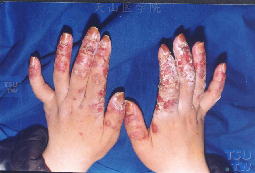系统性红斑狼疮-双手红斑萎缩、坏死结痂性血管炎样损害