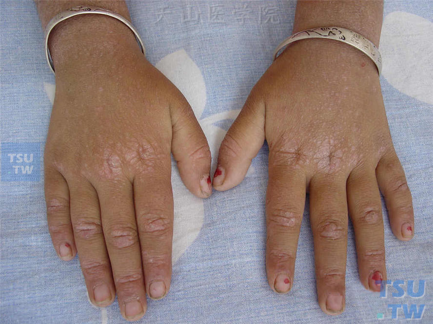 典型Gottron丘疹：掌指关节、指指关节伸侧扁平隆起丘疹