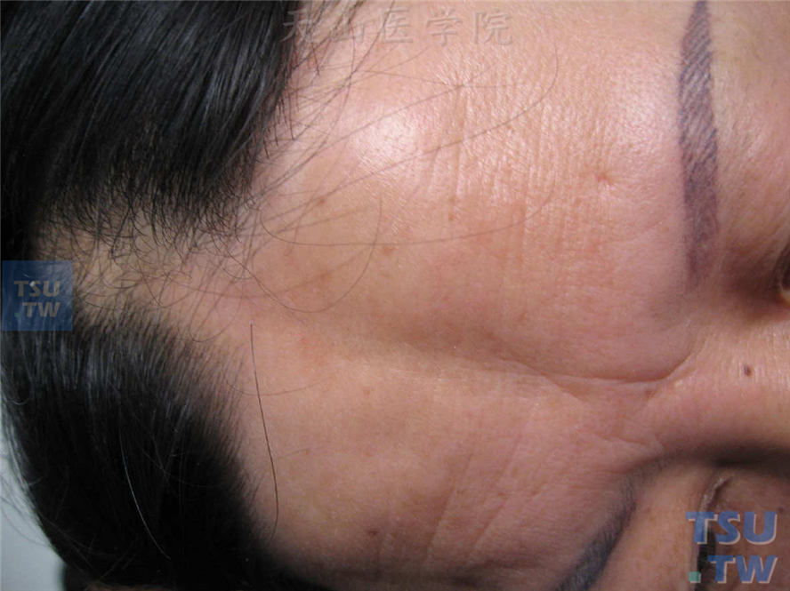 前额、头皮带状损害，触之发硬，中央萎缩，固定于其下方组织