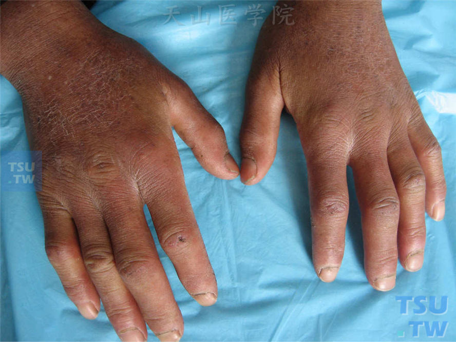 同一病人，手指硬化呈腊肠样，远端变尖，右手食指破溃不宜愈合