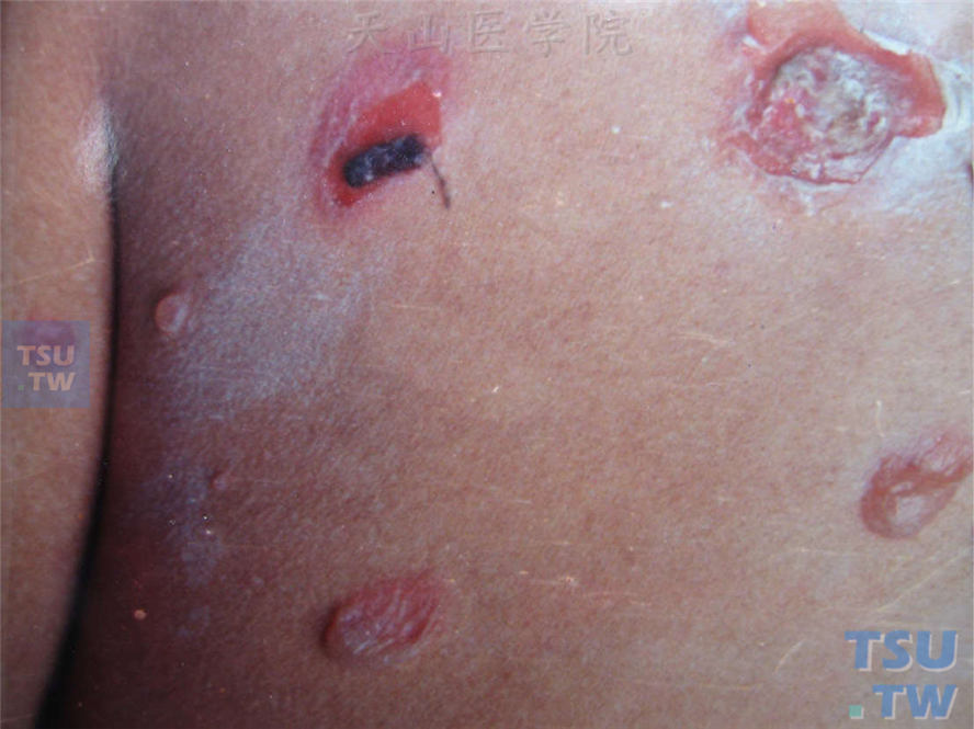红斑基础上松弛性水疱，壁薄，部分破溃形成糜烂面伴有结痂