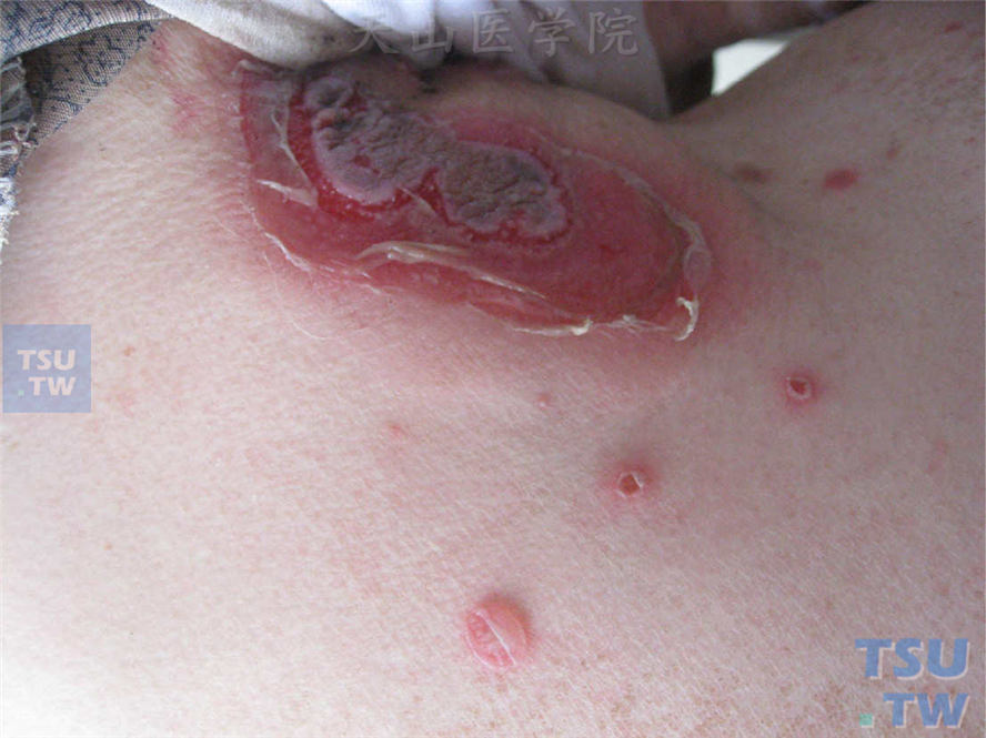 红斑或正常皮肤基础上松弛性水疱、大疱，部分破溃表面结痂