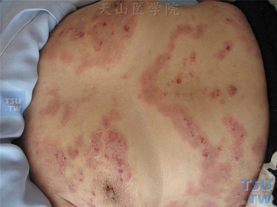 红斑型天疱疮（Pemphigus Erythematosus）症状表现