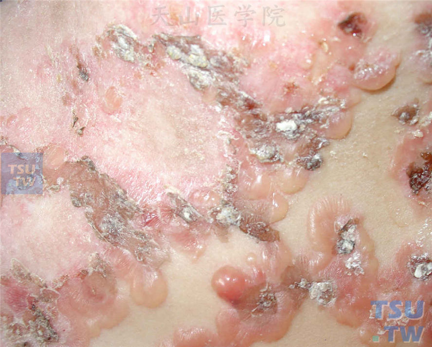 外观正常的皮肤或红斑基础上张力性水疱，呈弧形串珠状排列