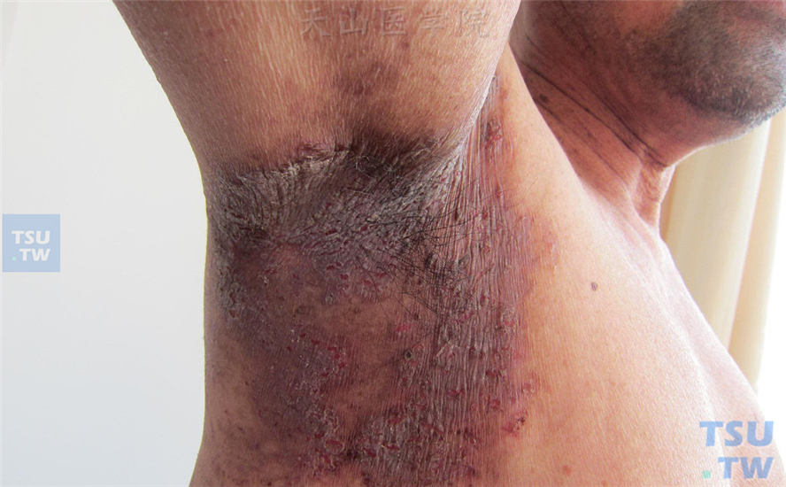 家族性良性慢性天疱疮：腋窝红斑、糜烂