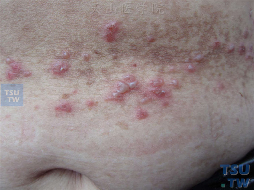 家族性良性慢性天疱疮：其妹妹腹部成群水疱、红斑、丘疹及色素沉着斑