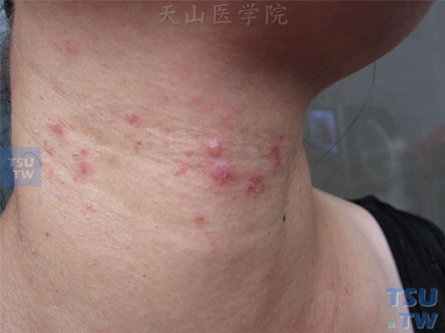 家族性良性慢性天疱疮：其妹妹颈部成群水疱、红斑及丘疹