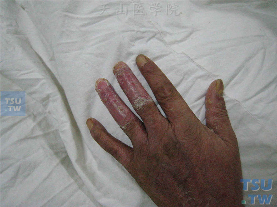左手中指及无名指背侧脓疱干涸后光泽性红斑，伴有甲沟炎，有外伤史