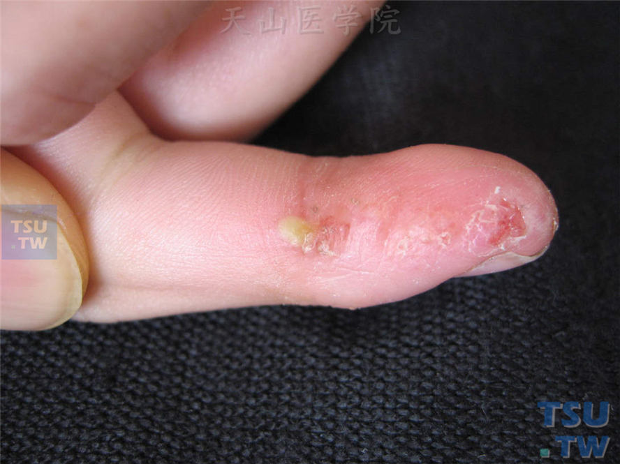 外伤后发生指端脓疱，干涸后脱屑