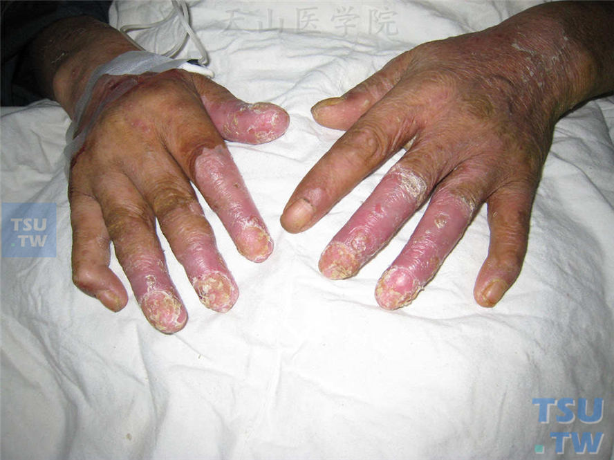 泛发型连续性肢端皮炎：手部皮损