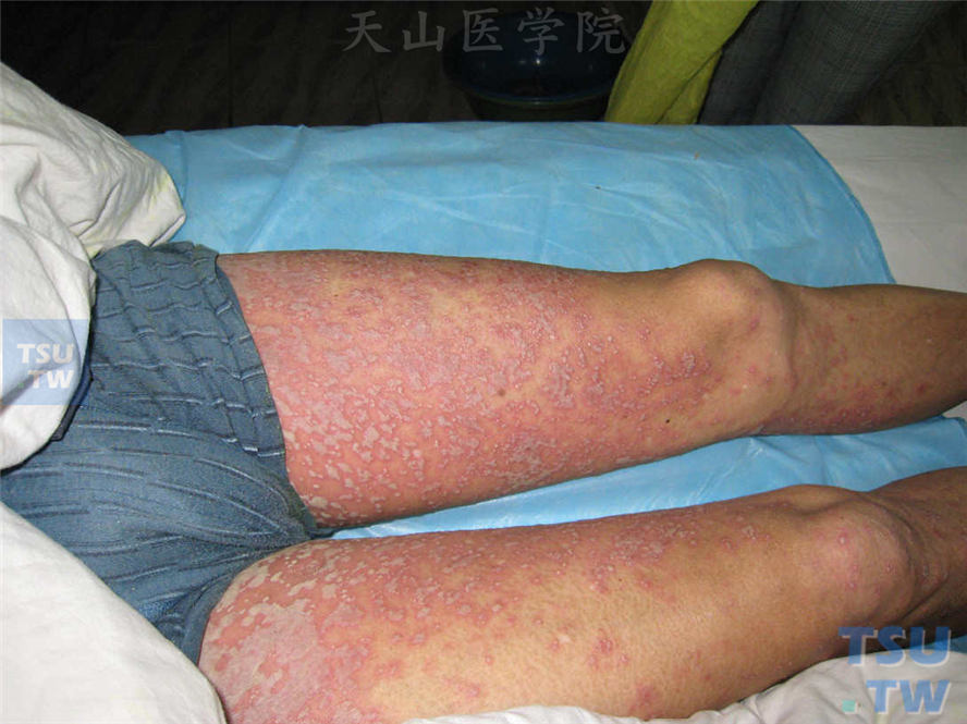 同一病人，双下肢红斑基础上密集浅表性脓疱