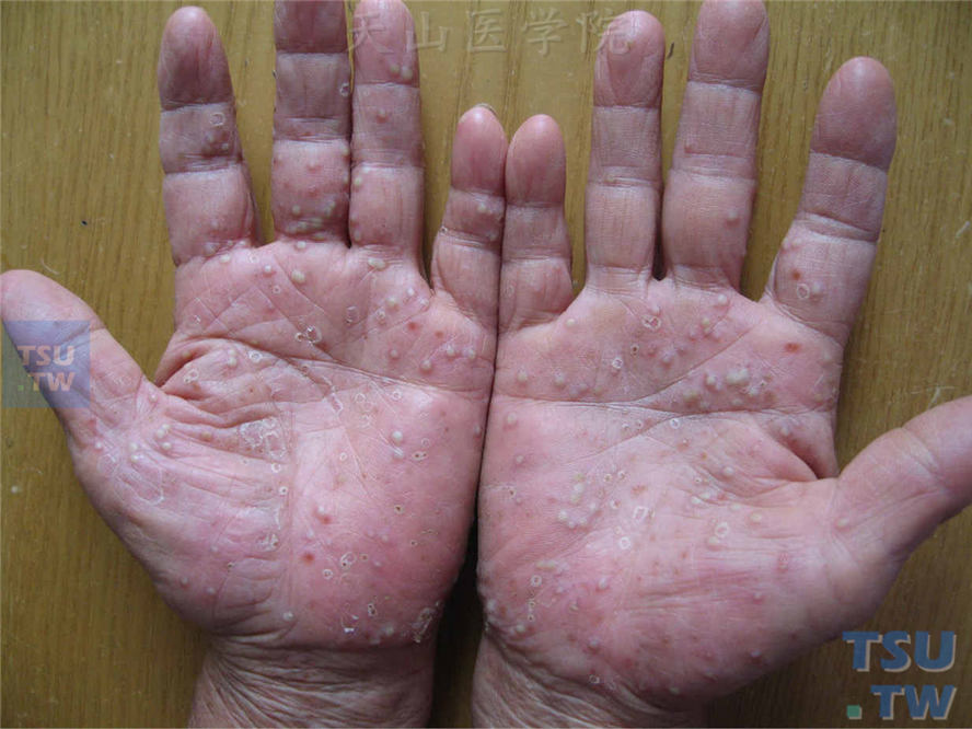 双侧手掌、手指掌侧红斑基础上粟粒至米粒大小脓疱，部分脓疱破裂或吸收表面为领圈状脱屑
