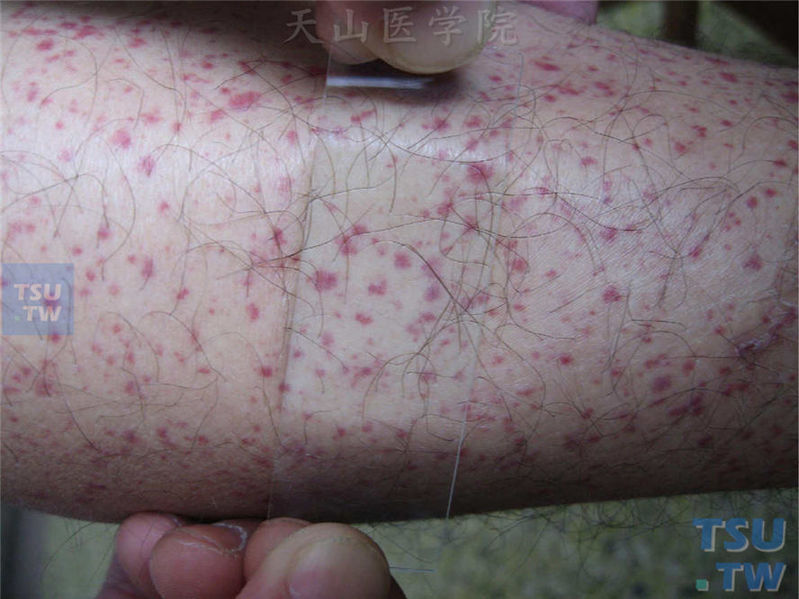 过敏性紫癜（anaphylactoid purpura）症状表现