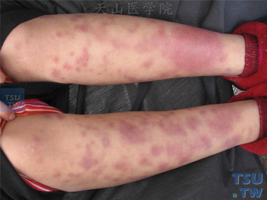 双小腿伸侧大小不等紫红色疼痛性结节