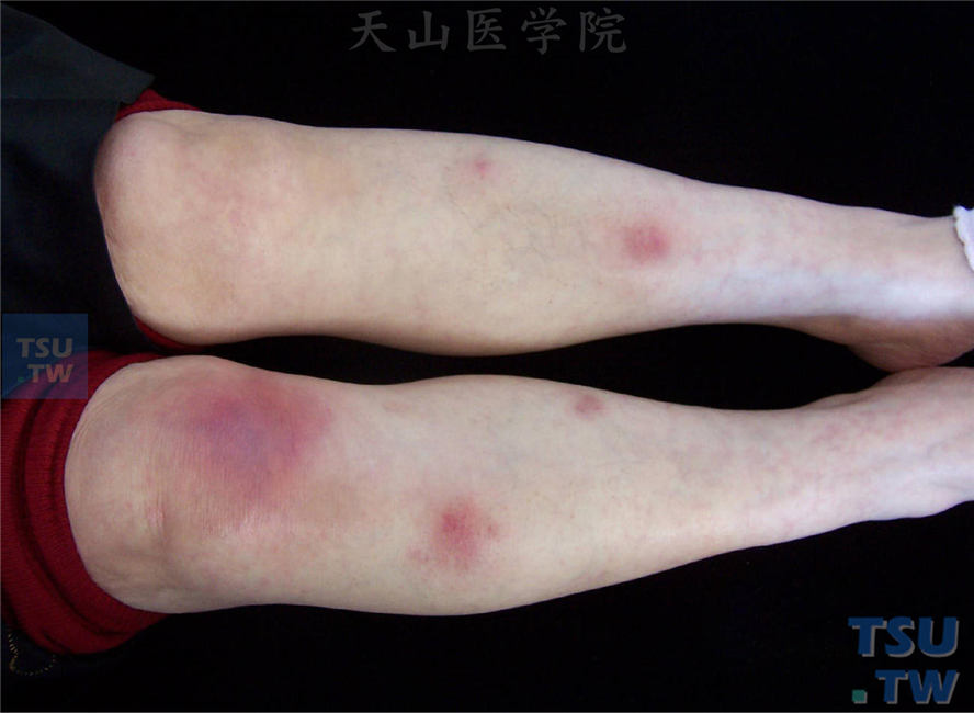 双小腿伸侧对称发生大小不等紫红色疼痛性结节，陈旧皮损吸收后留色沉