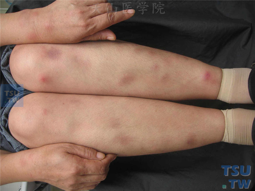 患者四肢散在大小不等紫红色疼痛性结节，边缘不清