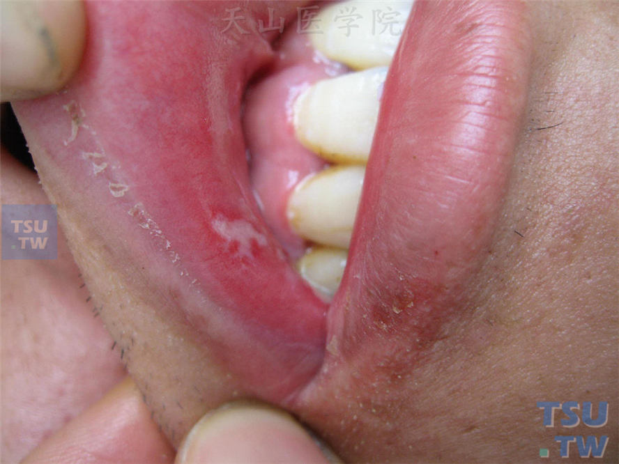 白塞病（bechet disease）症状表现