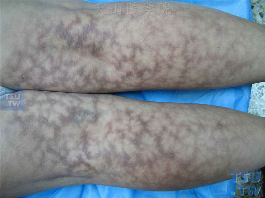 下肢屈侧皮肤对称性网状青紫色斑纹，斑纹间皮肤正常或苍白，呈大理石样