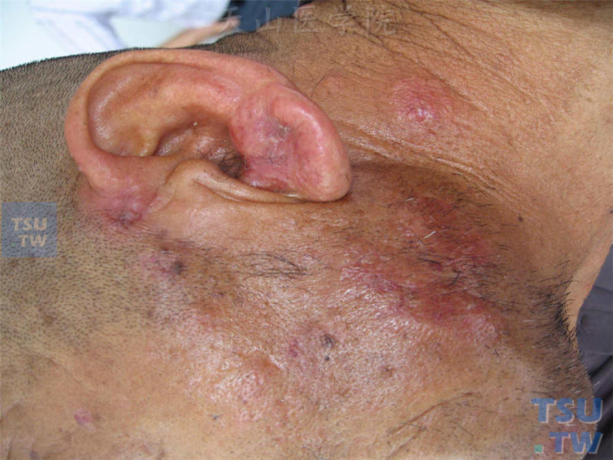 面颈部紫红色浸润性斑块，边缘呈粗颗粒状，为假水疱样