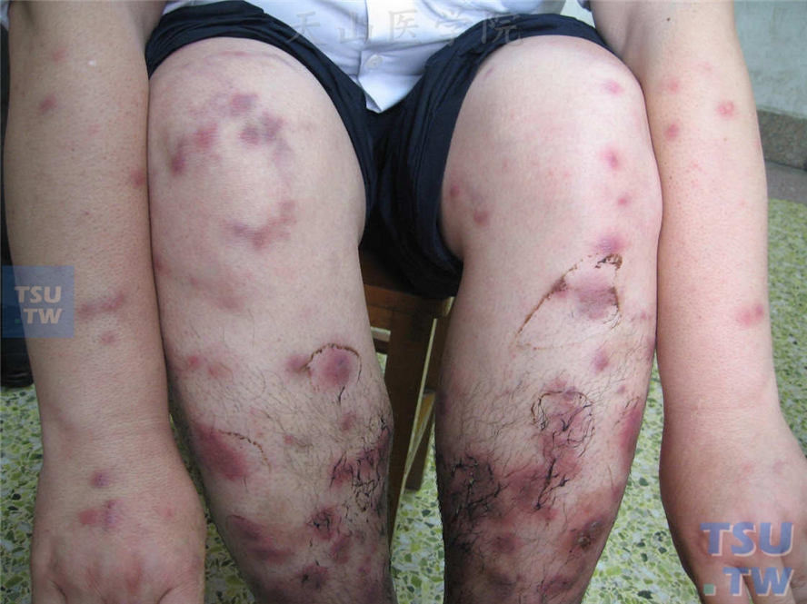 青年女性，四肢伸侧发生浸润性紫红斑，表面皮温增高，触痛，皮温增高