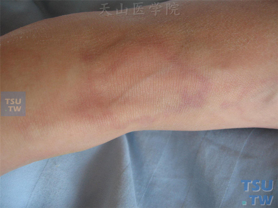 风团样水肿性红斑，但持续时间长，皮损边缘可见出血性损害