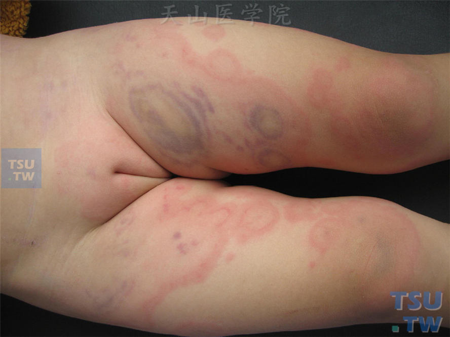 荨麻疹性血管炎（urticarial vasculitis）症状表现